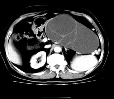 胰腺有哪些罕见病,胰腺上面最容易长的啥东西