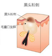 去黑头贴后如何收缩毛孔,去黑头的鼻贴撕不掉怎么办