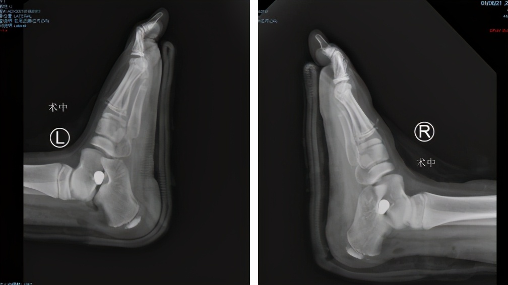 8岁小孩跑步总是跌倒怎么办,扁平足的孩子跑起来老是摔跤