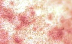 艾滋病窗口期皮肤瘙痒挠了会怎样,浑身皮肤瘙痒越挠越痒怎么解决