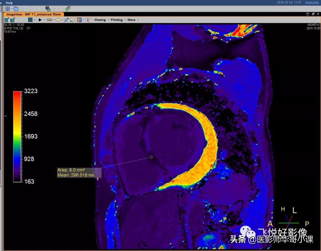 飞利浦磁共振快速扫描方案指南,飞利浦1.5t磁共振各部位扫描技术