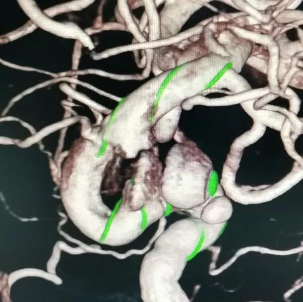 山东大学齐鲁医院王东海教授团队成功治疗多发性动脉瘤