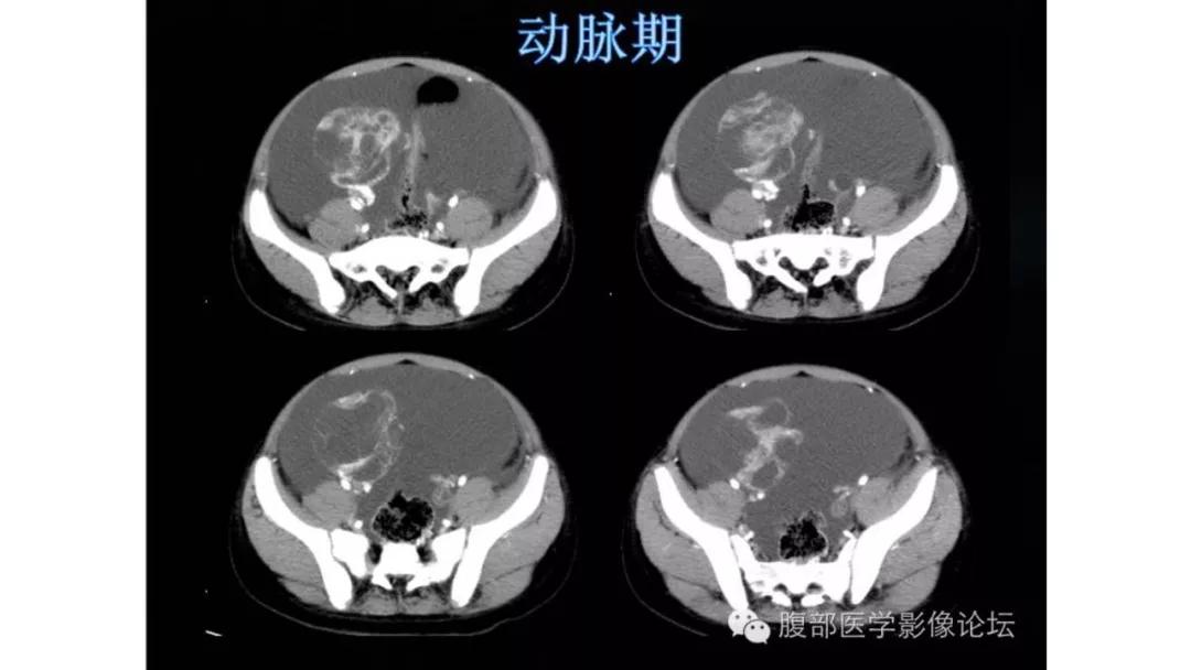卵巢原发肿瘤的分析思路