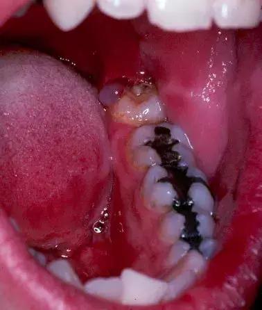 那些不拔智齿的人后来都怎么样了,那些该拔不拔的智齿最后都咋样了