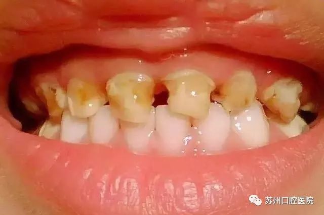 乳牙蛀牙清除真实全过程,小儿乳牙龋齿民间治疗偏方