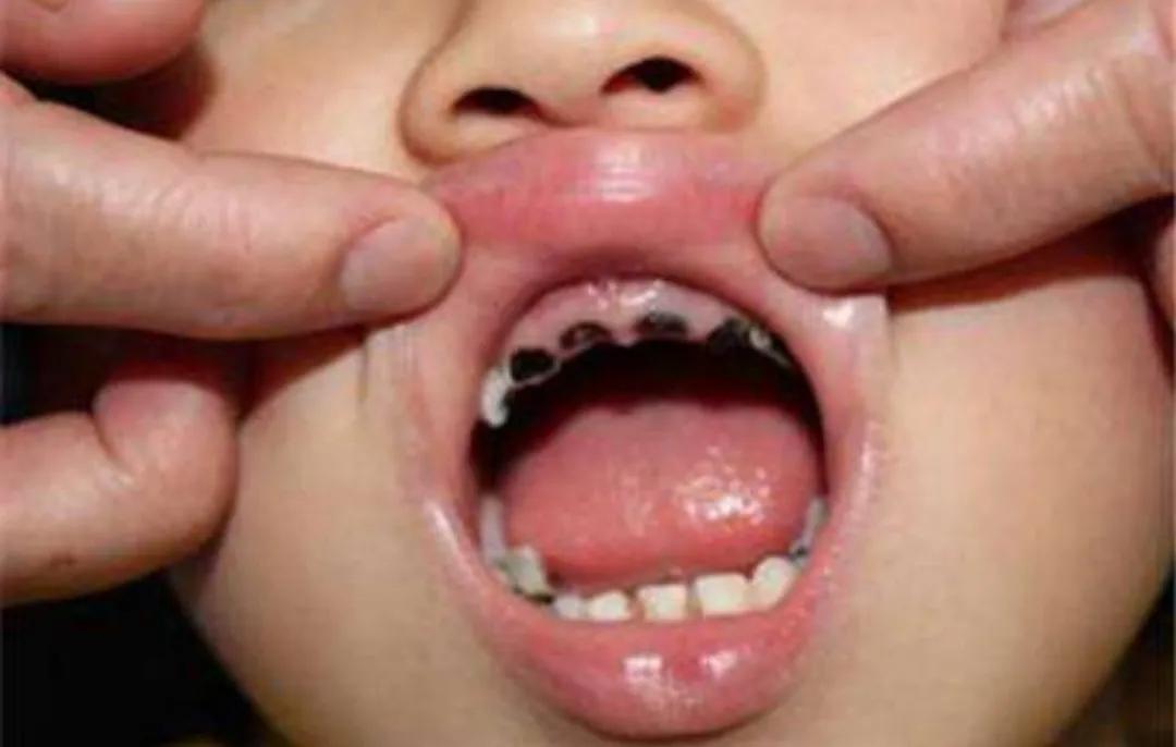 宝宝才三岁牙都坏了咋办,宝宝快三岁了牙齿才16颗