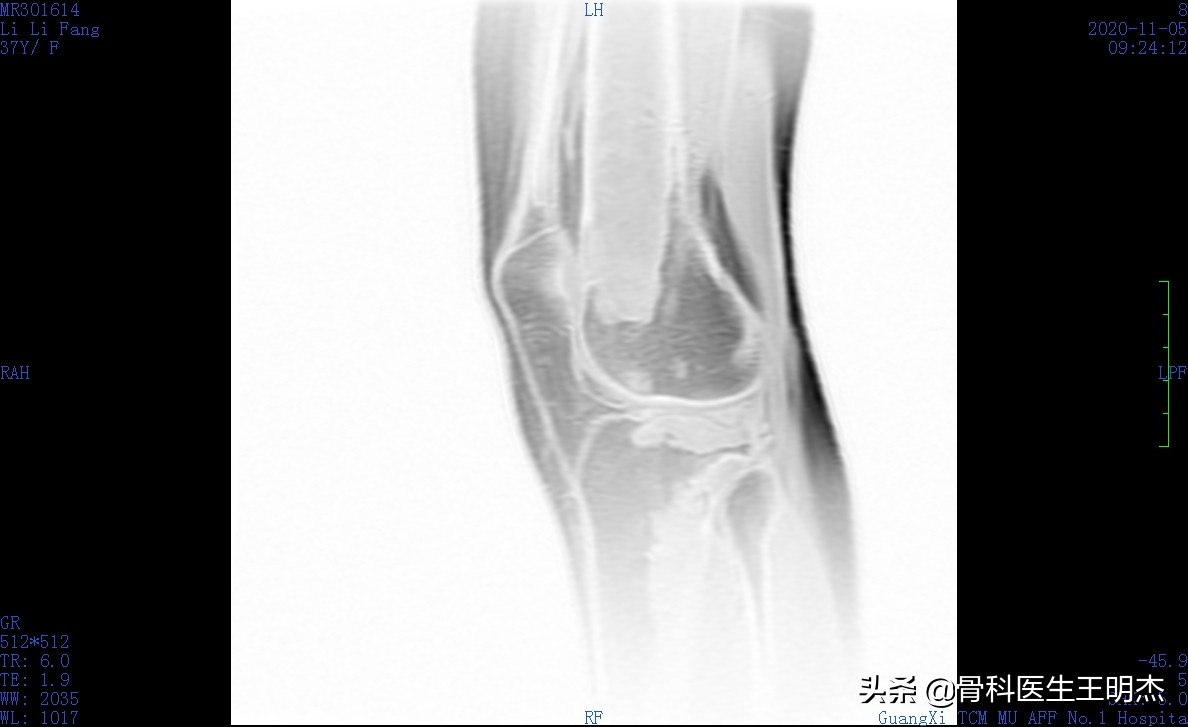 骨梗死是骨癌吗,骨梗死的治疗