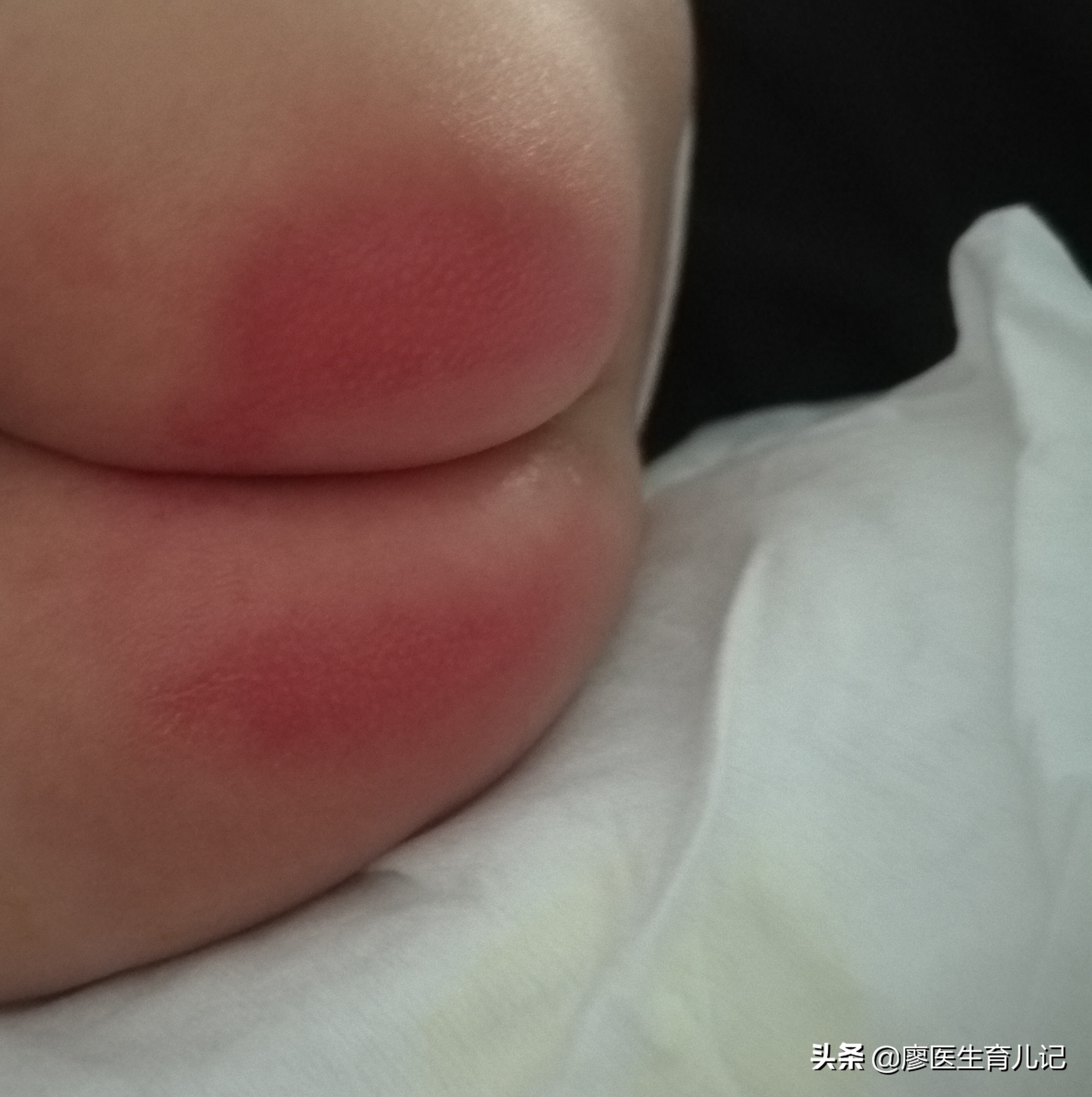 宝宝红屁股的如何预防和护理,宝宝红屁股怎么办教你一招