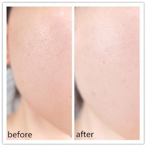 今天治疗,明天上班,激光中的“法拉利”超皮秒