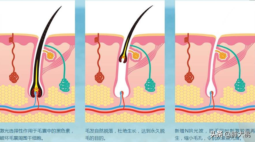 毛发越刮越粗？怎么脱毛让夏季不做“猕猴桃”女孩