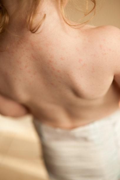 脸上抹完红霉素软膏还能抹日霜吗,可以把红霉素软膏涂抹脸上吗