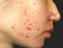 丘疹性痘痘肌肤怎么治疗,如何彻底根治丘疹型痘痘