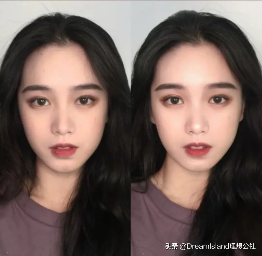 玻尿酸高光排名,打玻尿酸高光推荐