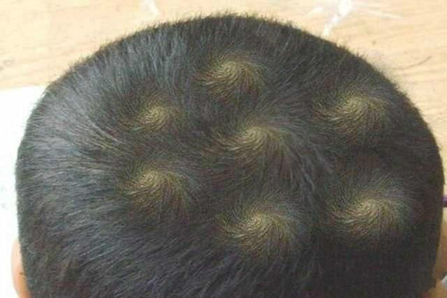 宝宝头旋偏有什么说法吗,宝宝头旋在哪个位置好