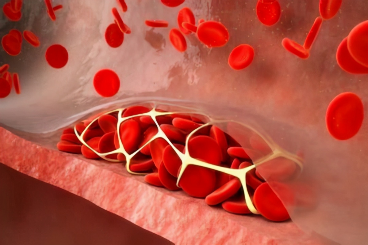 非独立性疾病——播散性血管内凝血，深入了解，掌握其治疗方法