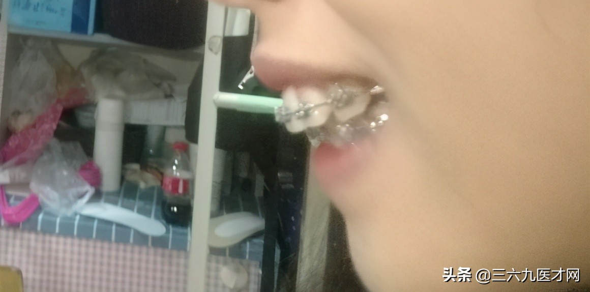 龅牙矫正成功的图片对比,2周岁龅牙可以矫正吗