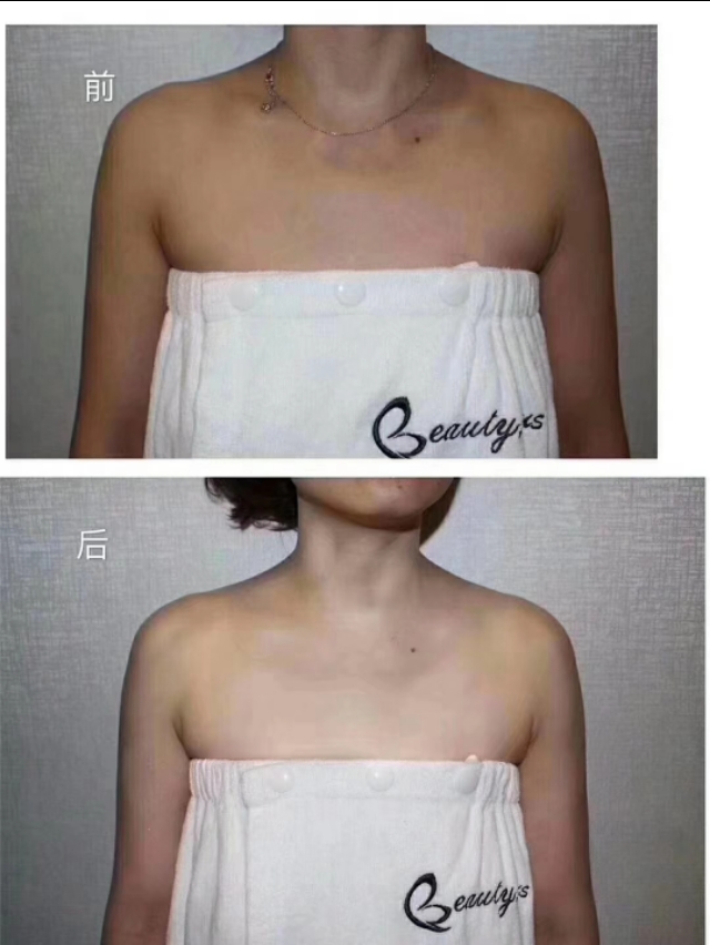 祛黑头痘印痘坑测评,净痘印去黑头精华推荐