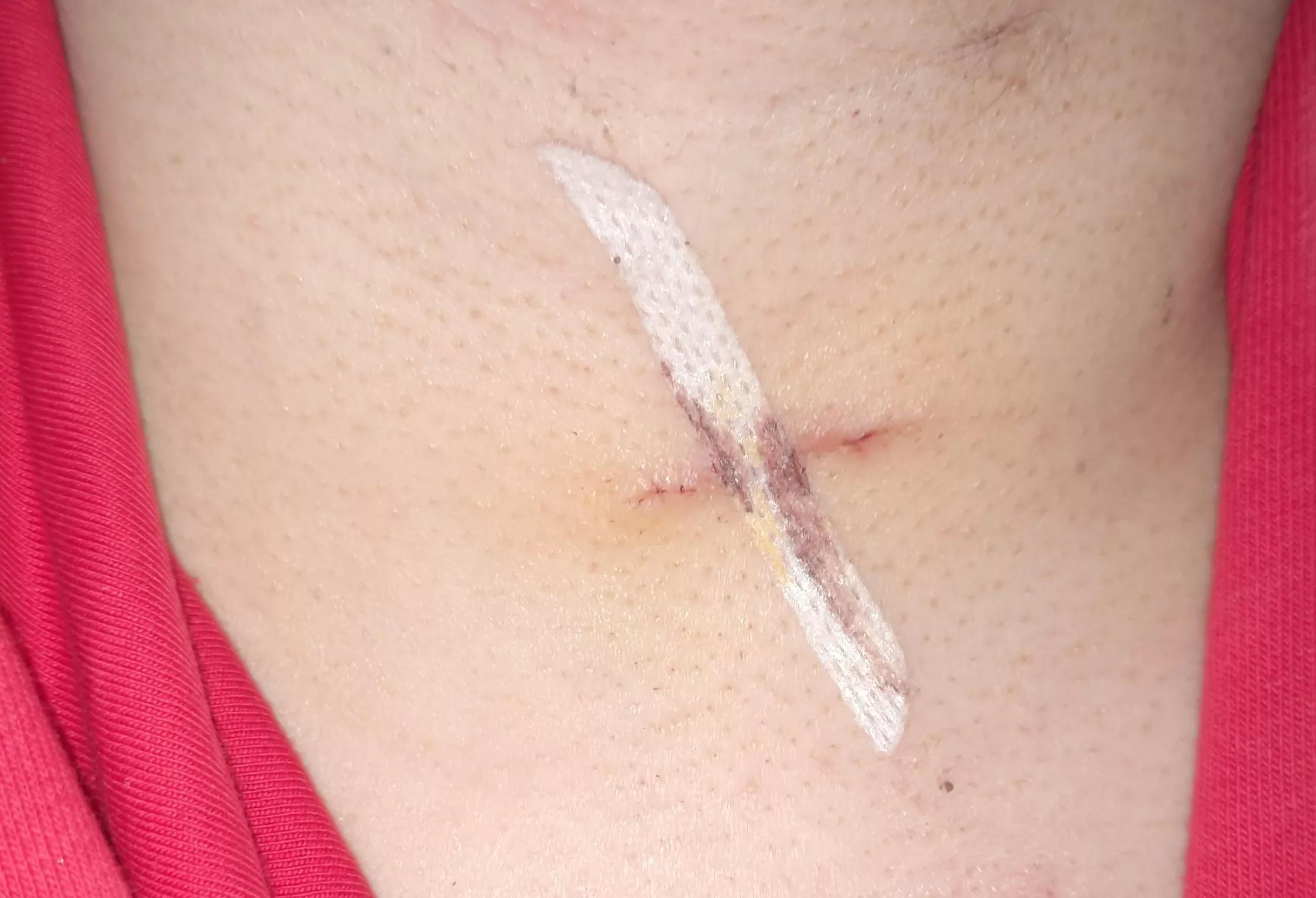 各种皮肤缝合伤口的方法对比