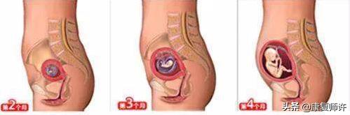 产后腹直肌分离的解决方法,产后腹直肌分离怎么处理