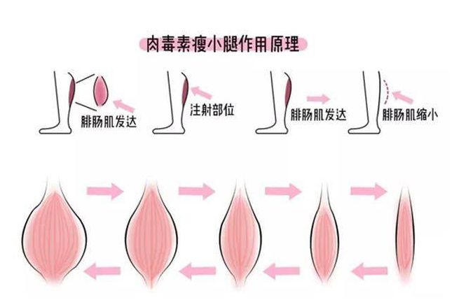 肉毒素科普视频,怎样知道肉毒素医生打了多少