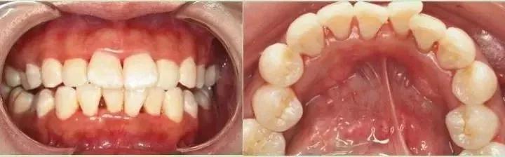 刷牙草草结束，不认真刷，最后可能就会变成这样子