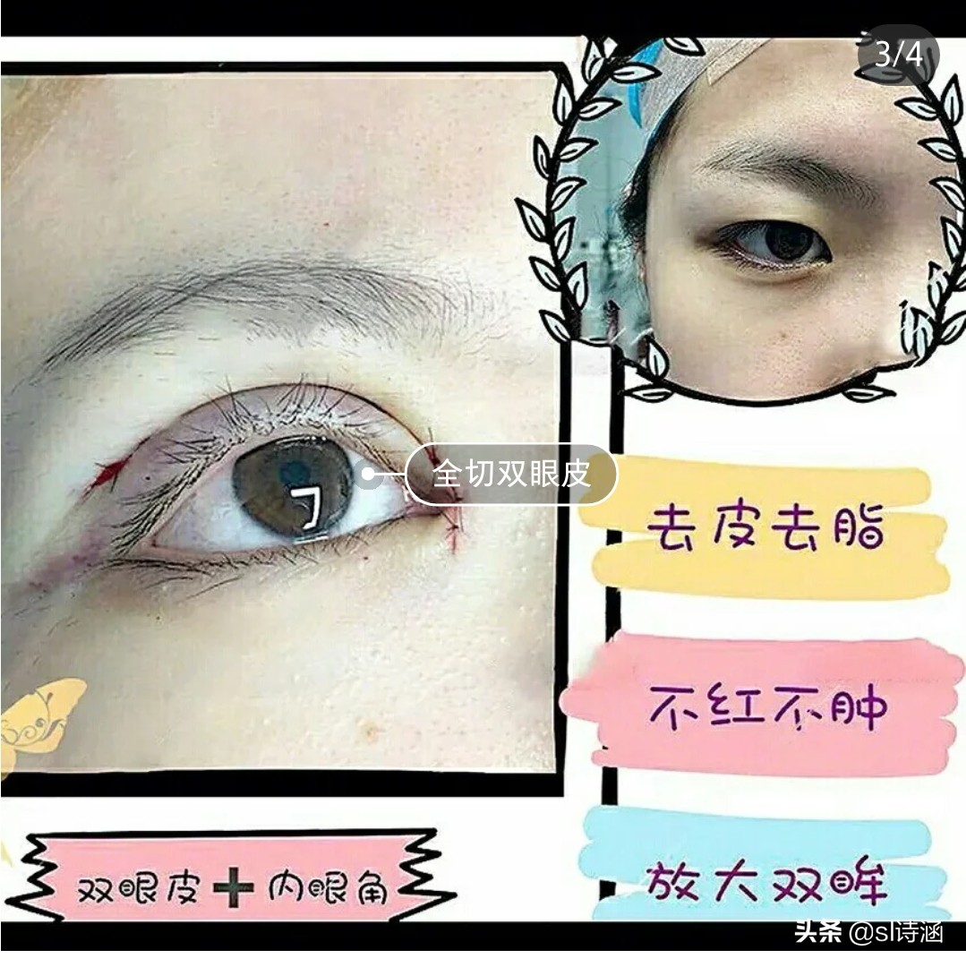 做完双眼皮之后有什么注意事项,做完双眼皮过后应该注意些什么
