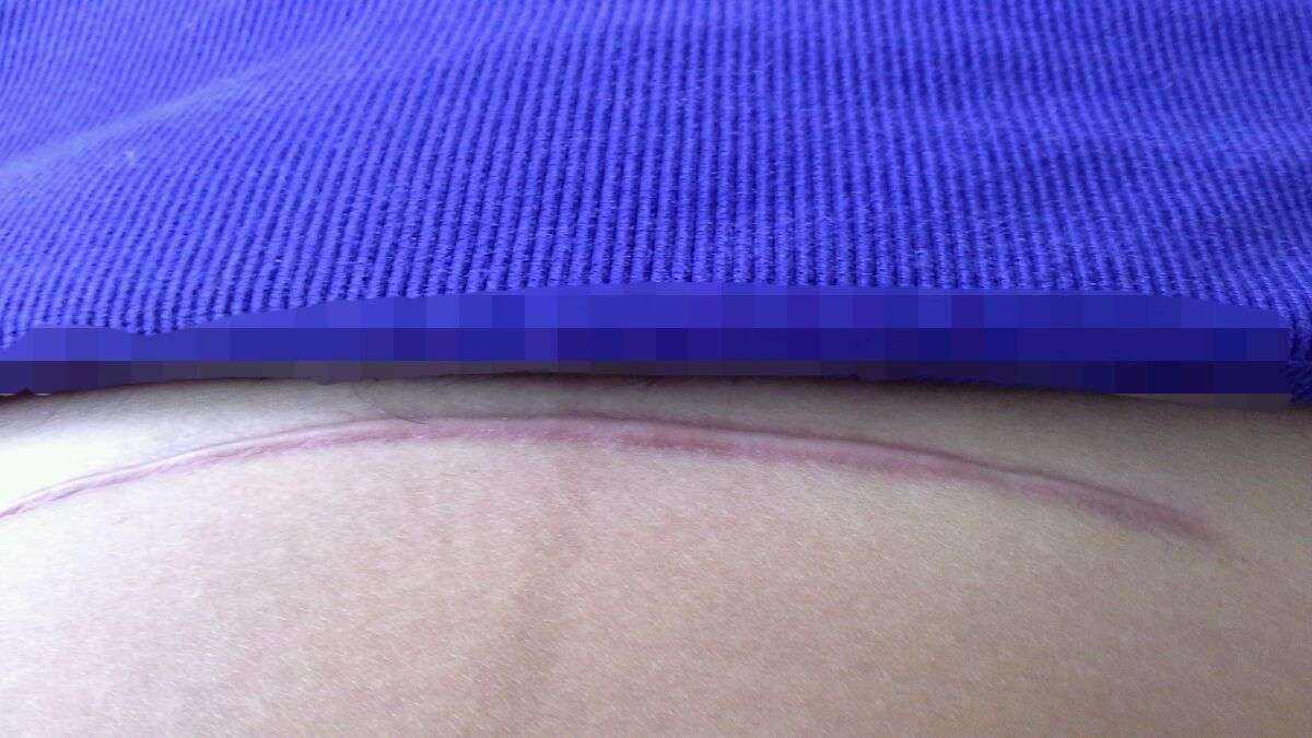 一胎剖腹产二胎顺产条件,头胎剖腹产二胎顺产的条件