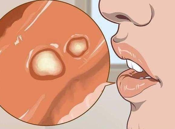 宝宝口腔溃疡缺什么,小孩脾胃积热口腔溃疡食疗