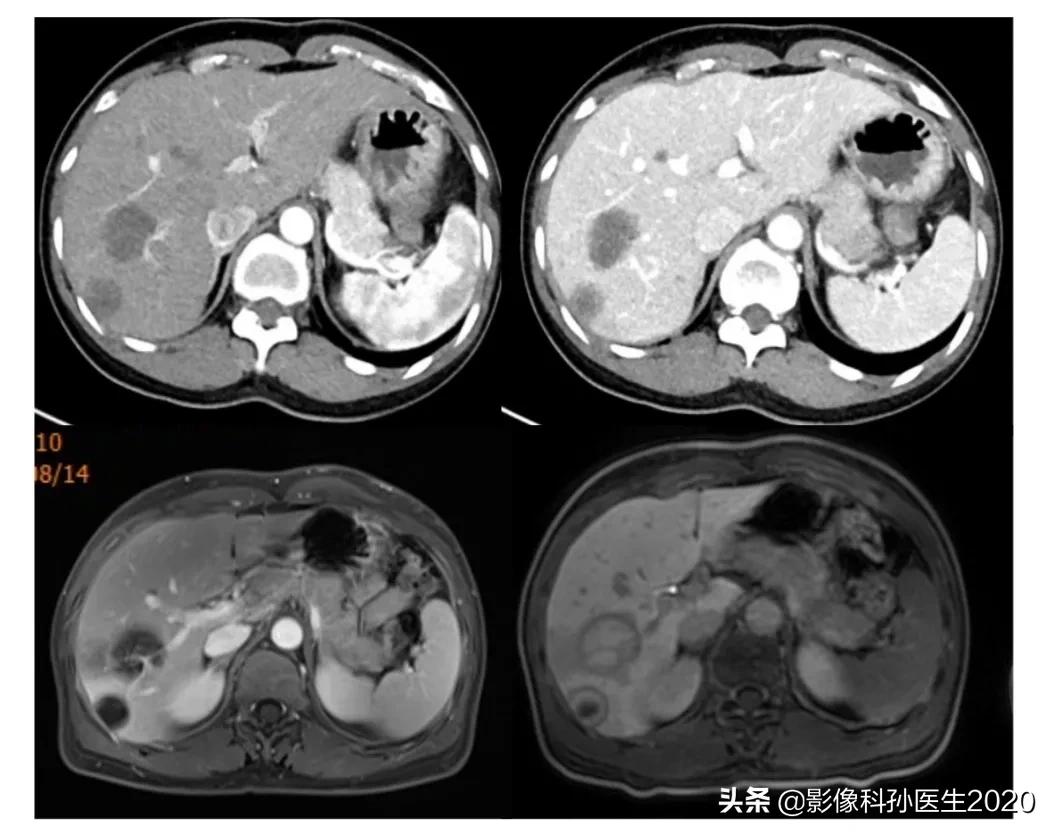 肝上皮样血管内皮瘤全国多少例,肝上皮样血管内皮瘤超声表现