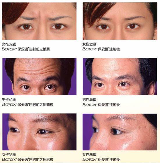 注射除皱玻尿酸和除皱针要怎么选,注射除皱和填充