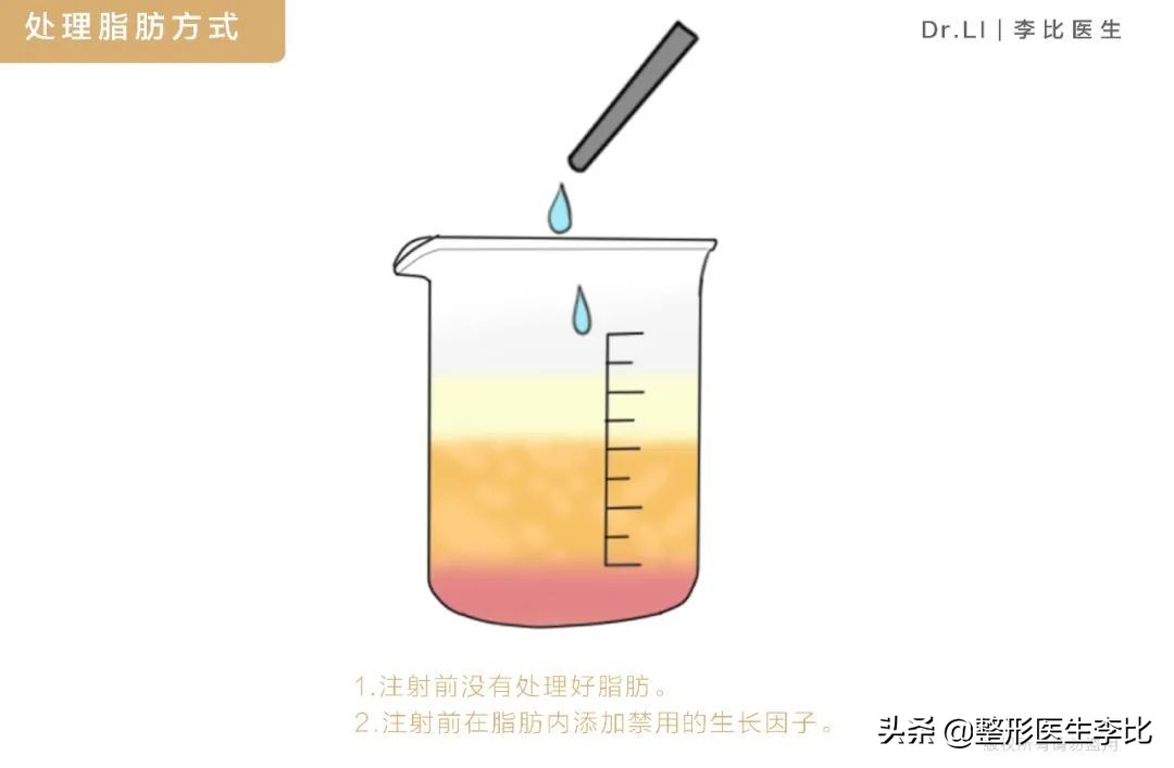 隆胸半年之后胸部有囊肿正常吗,脂肪隆胸以后胸部周围有小疙瘩