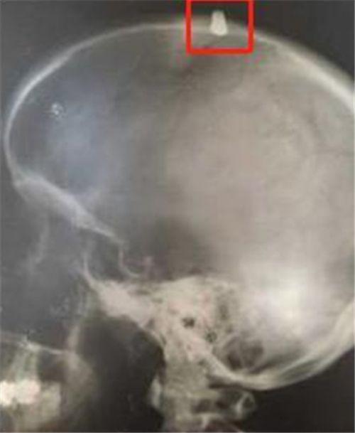 他被*弹子**击中额头,误以为是石子,跑完52里后,不料还有意外收获