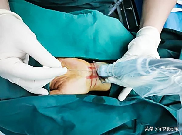 手麻、手痛、手无力？疼痛科一招帮您告别“鼠标手”