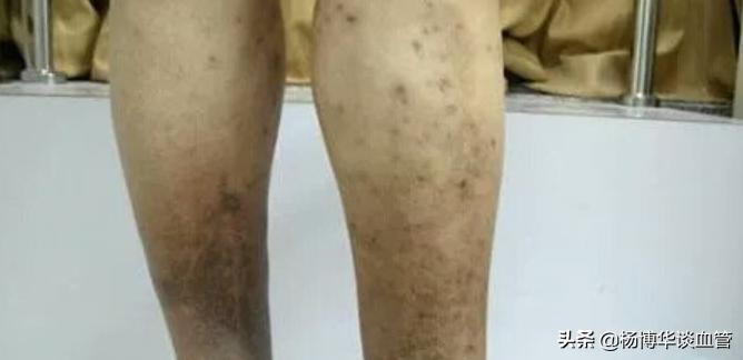 小腿静脉血栓做什么运动好,预防下肢静脉血栓的运动视频