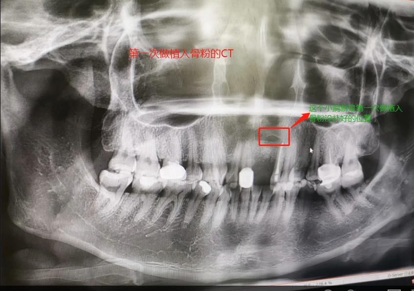 种门牙的亲身经历,种牙的心酸历程全文