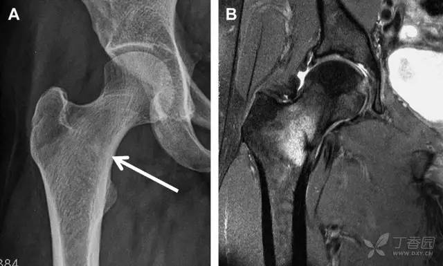 常见的八种骨折,容易漏诊的肩关节骨折