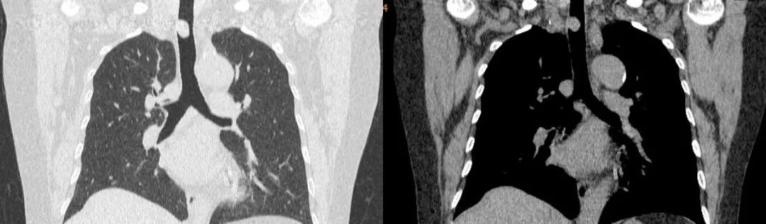 儿童90%为良性，成人却不到10%？患者气短3年，胸部CT提示的气管肿物意味着什么？气管镜有何发现？