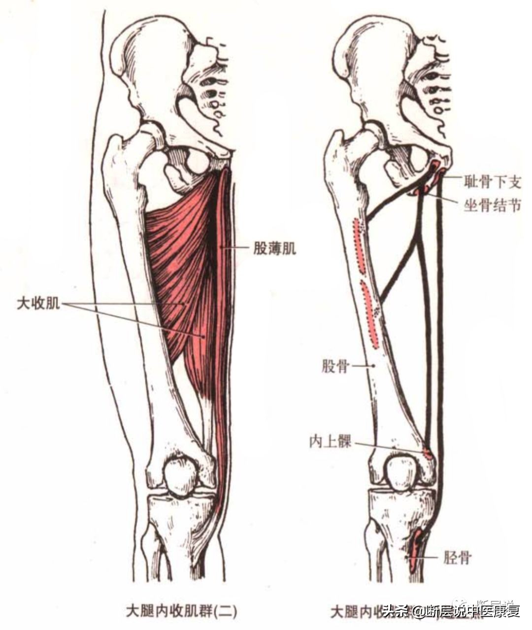 妇科盆腔疼痛症,盆腔筋膜炎如何彻底治愈