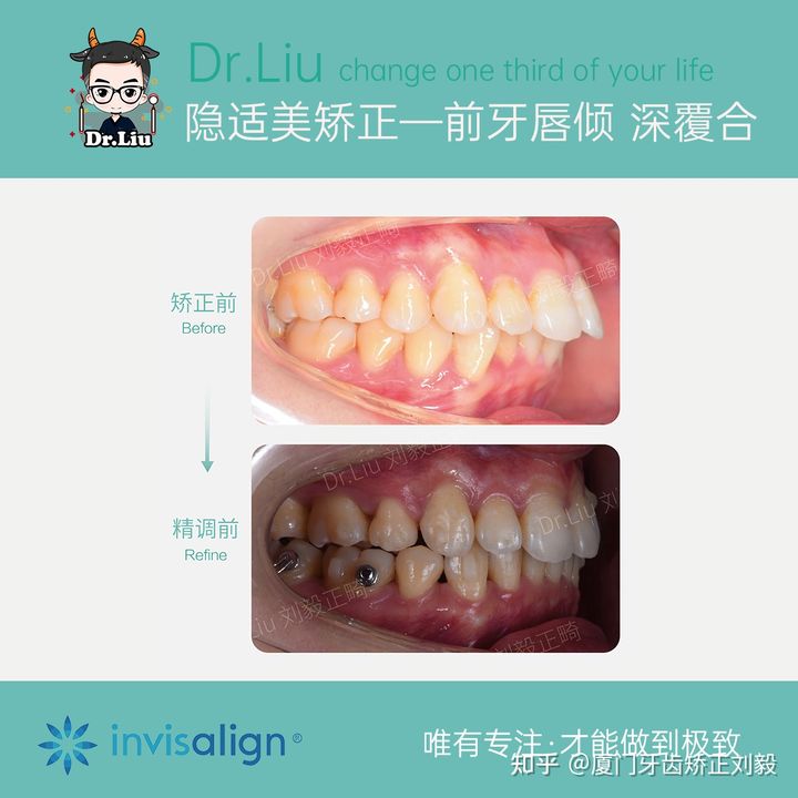 厦门透明牙齿矫正器矫正时间,厦门成人隐形牙齿矫正价格