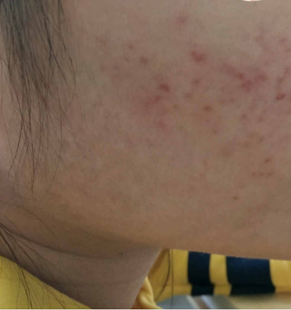 祛痘痘祛痘印,祛痘痘祛痘印的药膏推荐