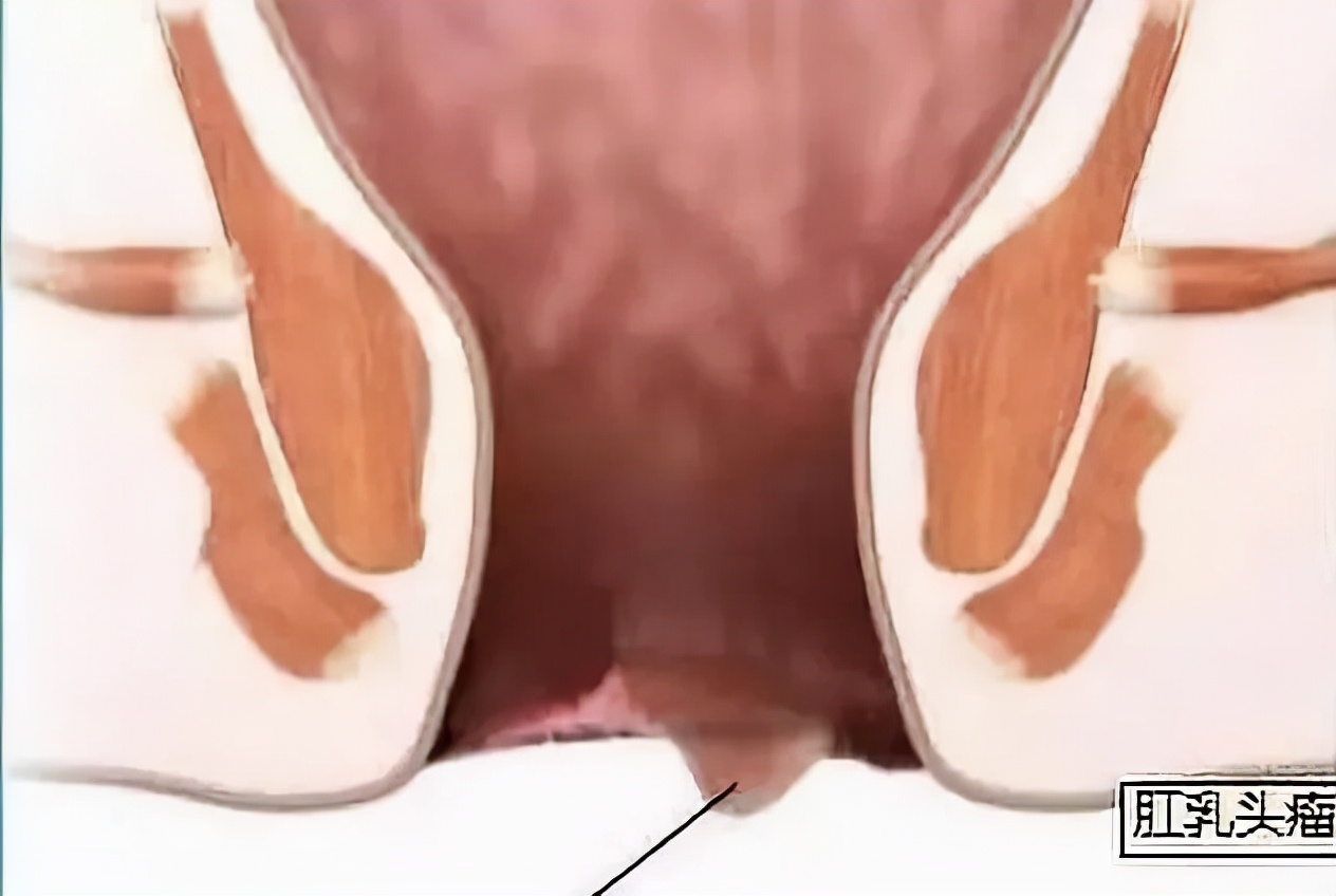 屁股里总感觉夹了个东西怎么办,肛门坠胀是焦虑引起的躯体症状吗