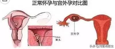 注意啦,你是宫外孕高危人群吗?