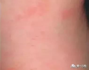 手足口病水痘荨麻疹有什么区别,麻疹水痘手足口病皮疹的区别