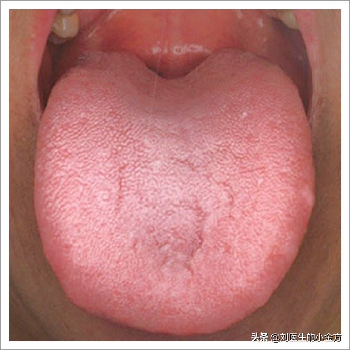 中医舌诊对照表100例,舌诊辨九大体质