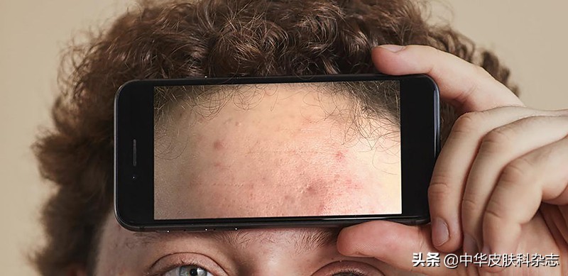 战痘全攻略详细解析,战痘全攻略详细