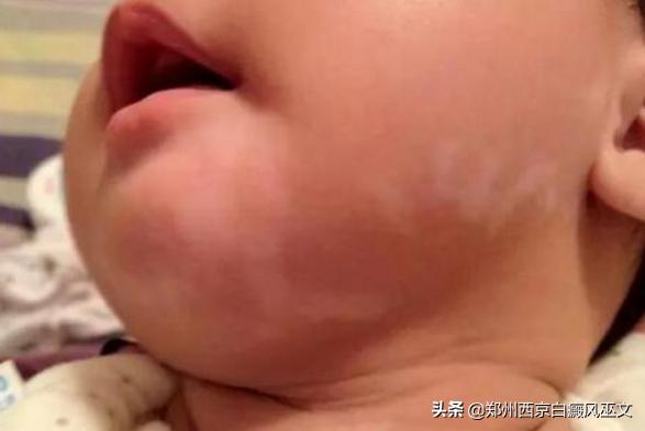 婴儿会出现白癜风吗,婴儿白癜风会发病在头皮吗