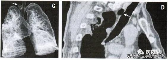 气管憩室ct影像,气管憩室在ct检查中容易辨别吗