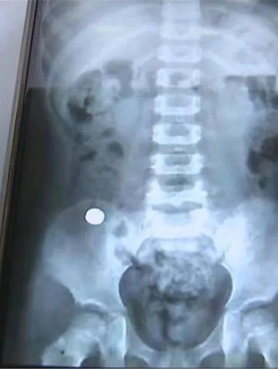 4岁男孩吃了它，体内充血水肿糜烂！快把家中这个东*藏西**好