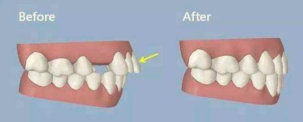 牙齿矫正后牙齿会变松吗,牙齿矫正为什么让我的牙齿松动了