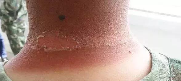 晒伤后绝对不能做的4件事,晒伤修复小妙招你绝对不知道